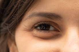 How to Reduce Dark Circles and Puffiness Naturally